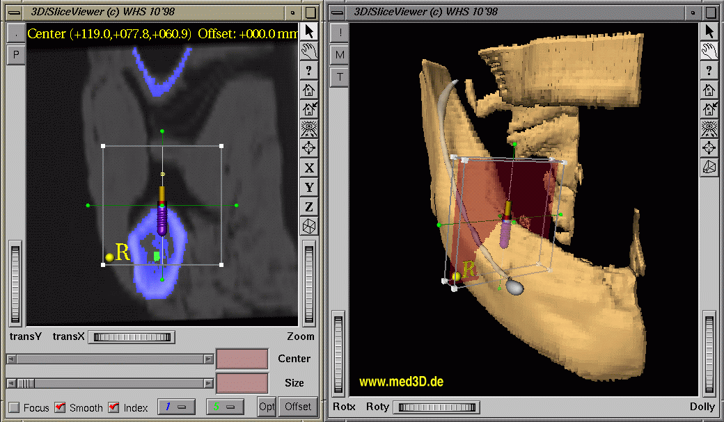 Interactive implant positioning in 2D & 3D